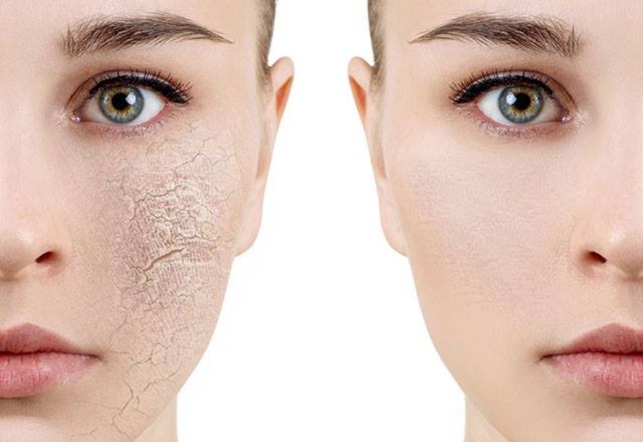 Sucha skóra – objawy, przyczyny, ujęcie w ,,Totalnej Biologii”, polecane produkty.