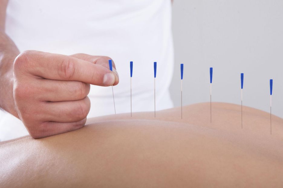 Akupunktura Czy działa?